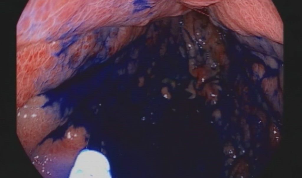 boyama yontemi ile mide ve bagirsak kanserinde erken teshis 36bfba25b089 |