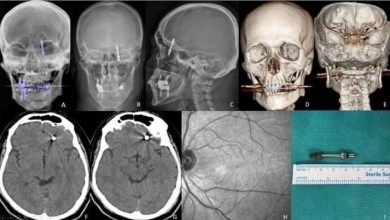 Beynine saplanan implant hayatını kararttı: 2 yıldır adalet bekliyor 5 beynine saplanan implant hayatini karartti 2 yildir adalet bekliyor 18f4976c9ba0 |