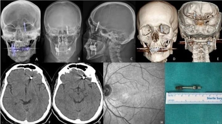 Beynine saplanan implant hayatını kararttı: 2 yıldır adalet bekliyor 1 beynine saplanan implant hayatini karartti 2 yildir adalet bekliyor 18f4976c9ba0 |