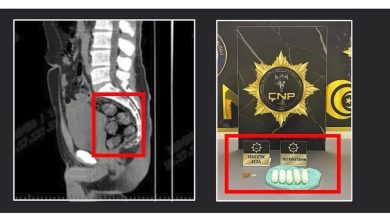 Tomografide şok eden görüntü...Uyuşturucu midesinden çıkarıldı 2 tomografide sok eden goruntuuyusturucu midesinden cikarildi 6840f418b5fc |