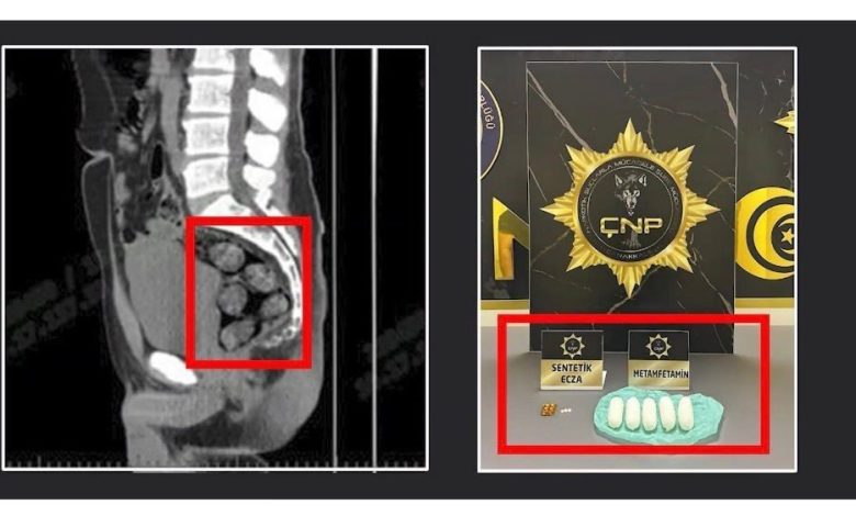 tomografide sok eden goruntuuyusturucu midesinden cikarildi 6840f418b5fc |