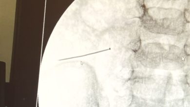 agriyla kivranan 2 yasindaki cocugun bagirsagindan 3 santimlik igne cikti 22811727aeb4 |
