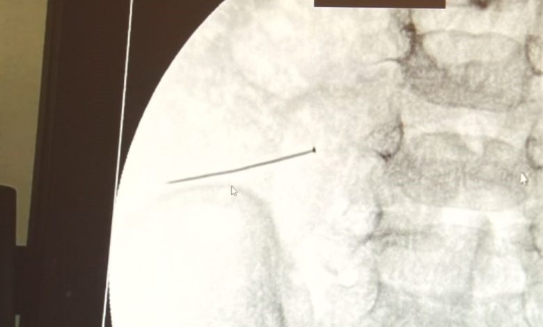 agriyla kivranan 2 yasindaki cocugun bagirsagindan 3 santimlik igne cikti 22811727aeb4 |