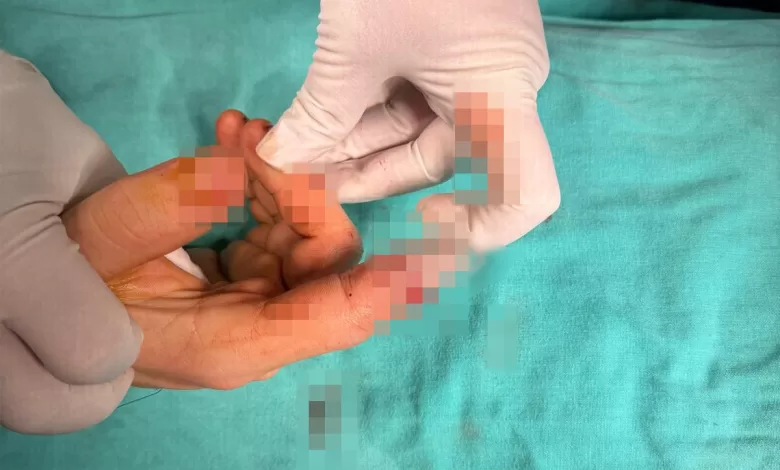 bandirmada asansor kazasinda kopan parmak basarili ameliyatla kurtarildi 3b5c7cbadbbf |